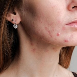 The Ultimate Guide to Treating Acne
